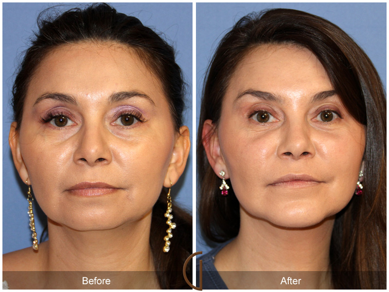 Chin Cheek Augmentation  Before & After Image