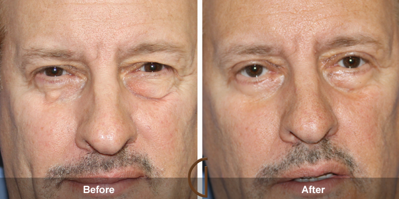 Eyelid Surgery Before & After Image