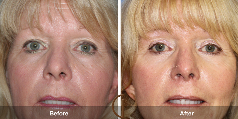 Eyelid Surgery Before & After Image