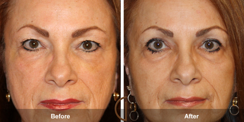 Eyelid Surgery Before & After Image