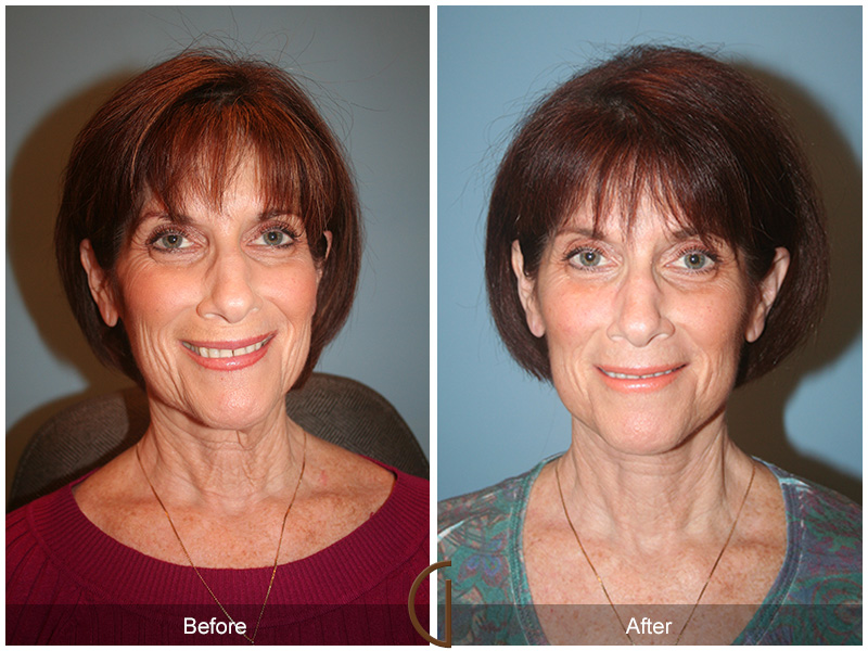 Female Facelift  Before & After Image