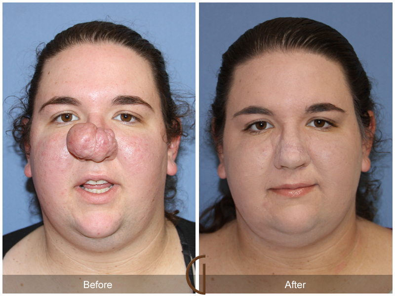 Female Rhinoplasty Before & After Image