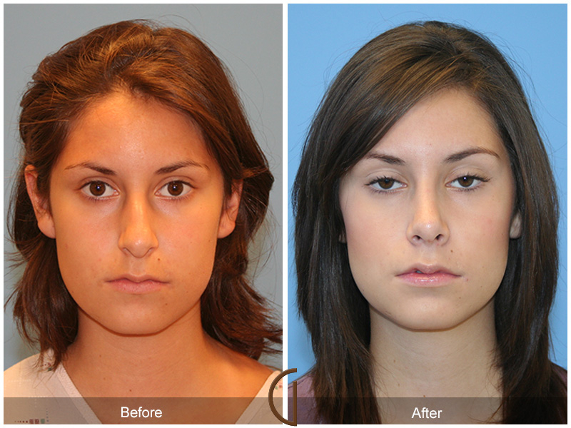 Teen Rhinoplasty Before & After Image