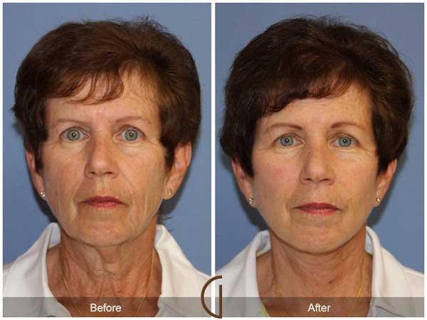 Before and after gallery for Orange County, Newport Beach facial plastic surgeon Dr. Kevin Sadati