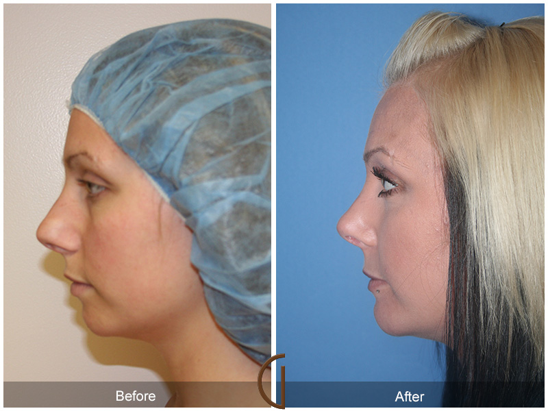 Chin Cheek Augmentation  Before & After Image