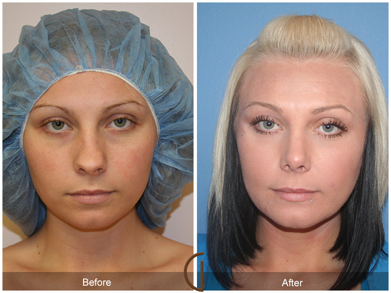 Chin Cheek Augmentation  Before & After Image