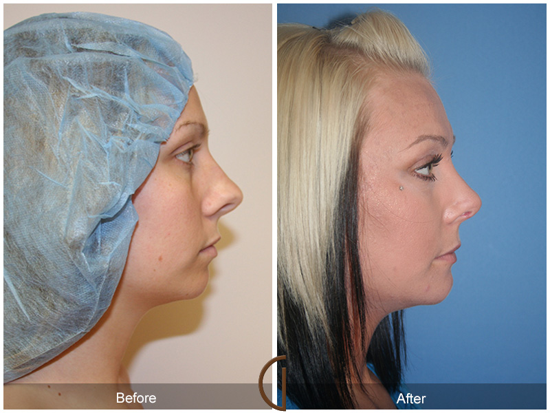 Chin Cheek Augmentation  Before & After Image