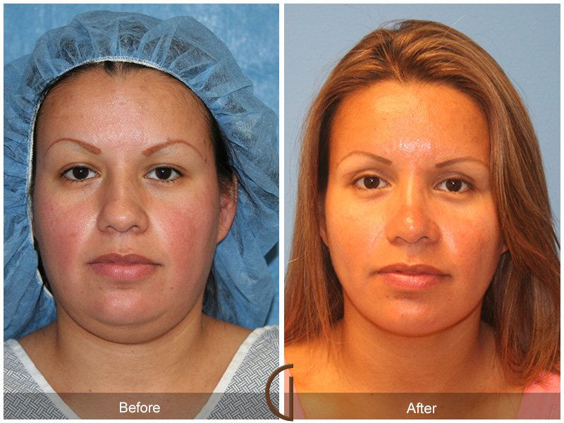 Chin Cheek Augmentation  Before & After Image