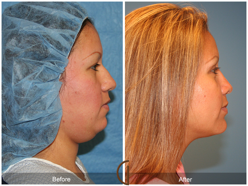 Chin Cheek Augmentation  Before & After Image