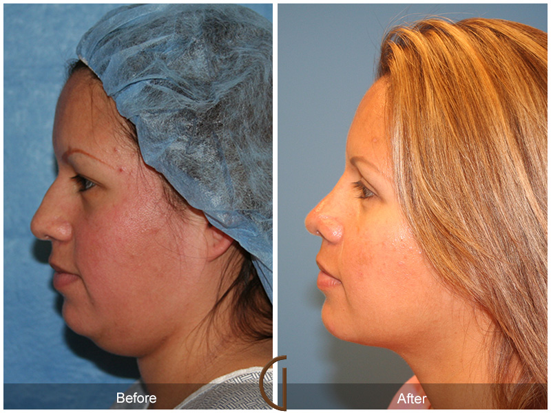 Chin Cheek Augmentation  Before & After Image