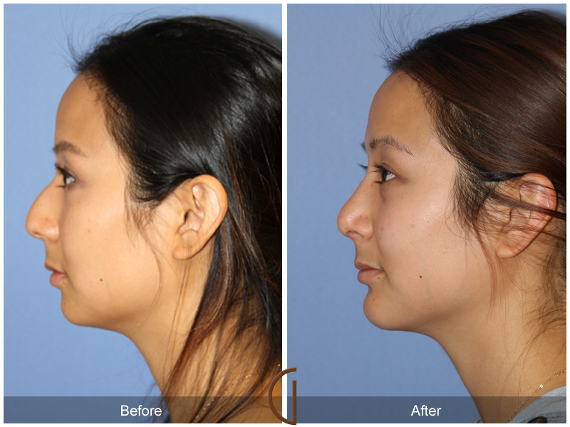 Chin Cheek Augmentation  Before & After Image