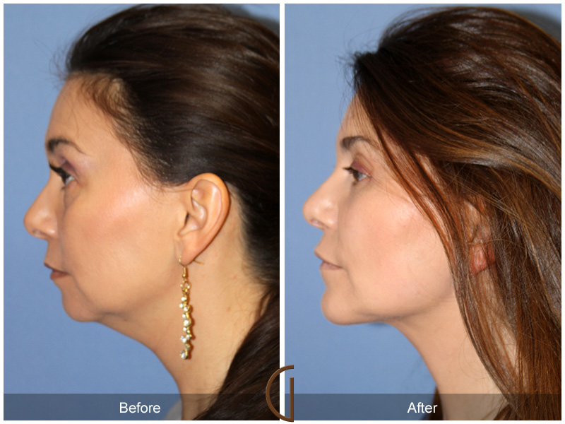 Chin Cheek Augmentation  Before & After Image