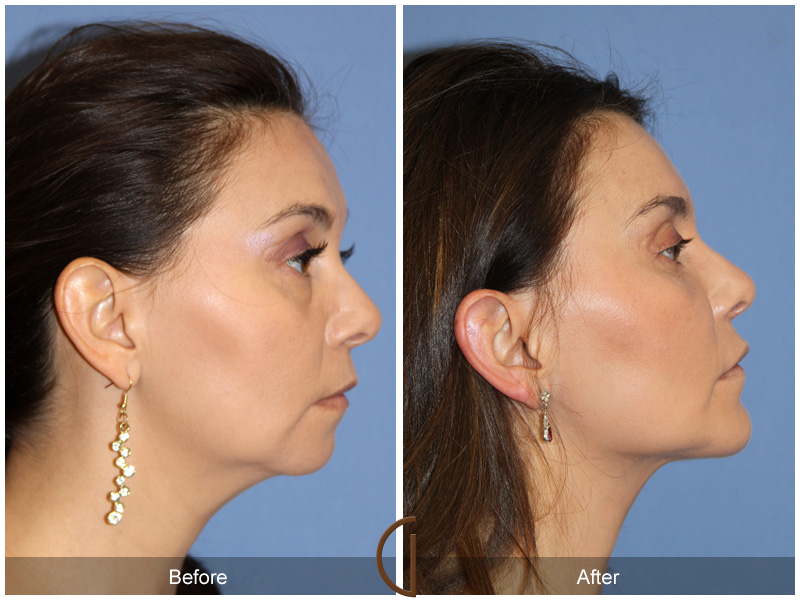 Chin Cheek Augmentation  Before & After Image