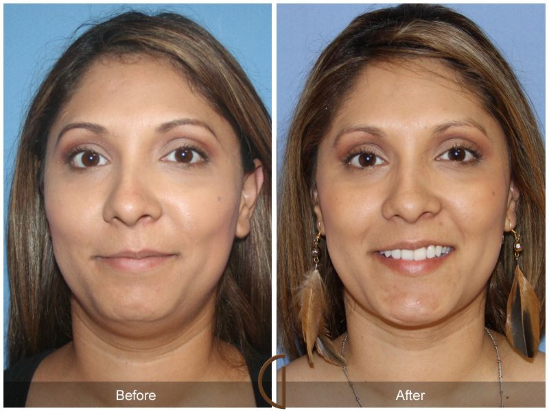 Chin Cheek Augmentation  Before & After Image