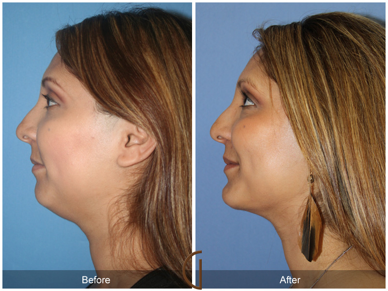 Chin Cheek Augmentation  Before & After Image