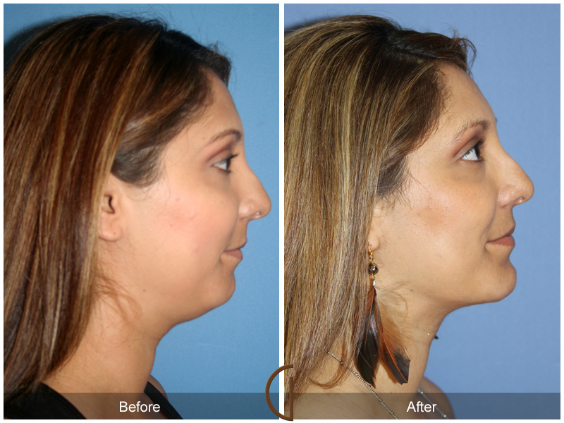 Chin Cheek Augmentation  Before & After Image