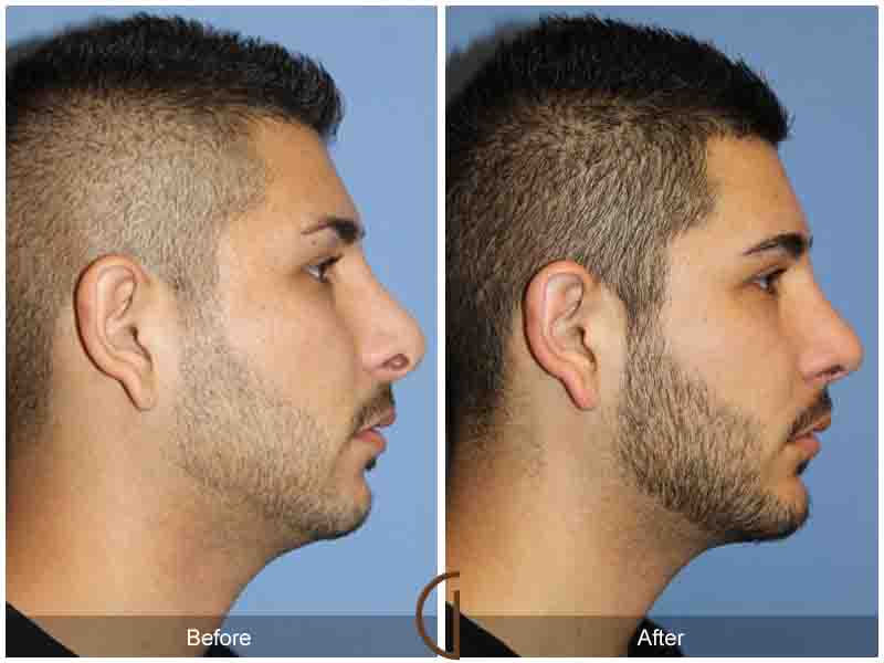 Chin Cheek Augmentation  Before & After Image