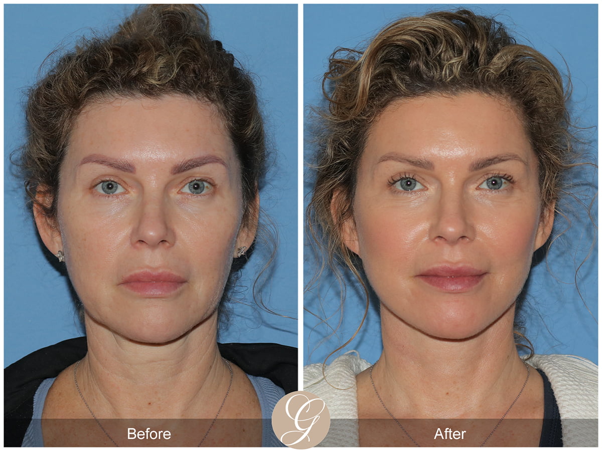 Face Galleries Before & After Image