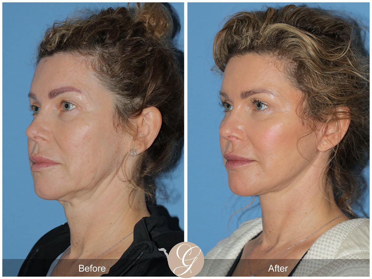 Face Galleries Before & After Image