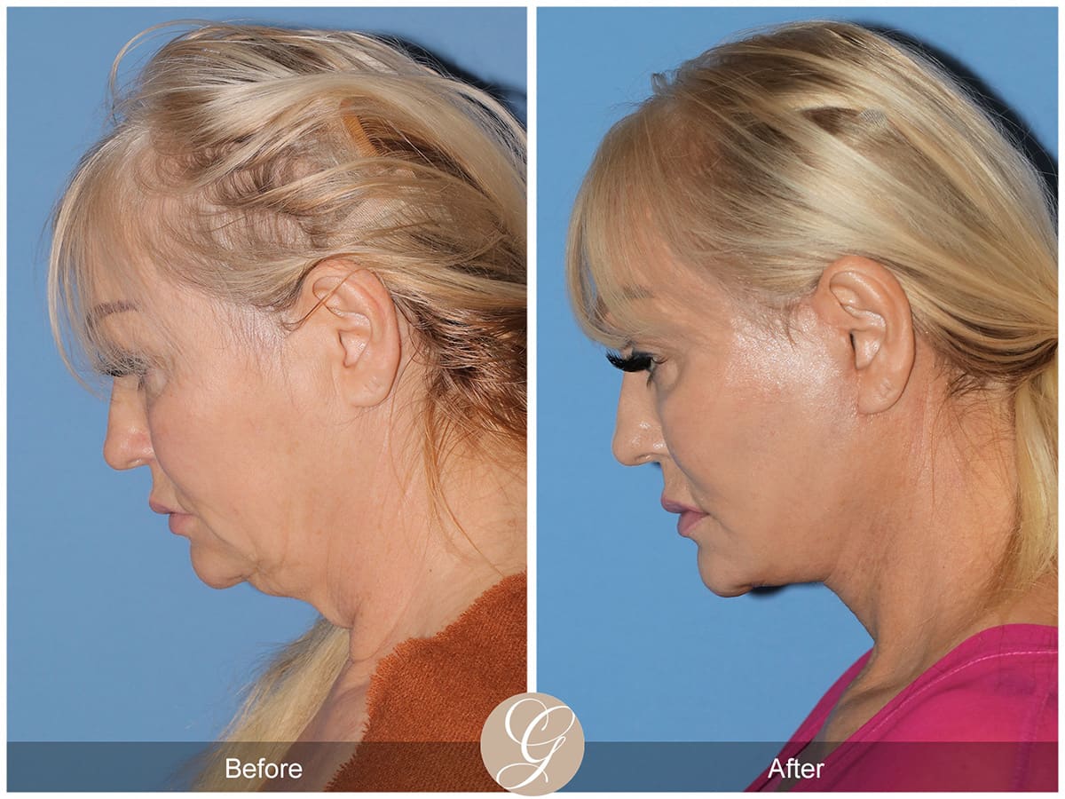 Face Galleries Before & After Image