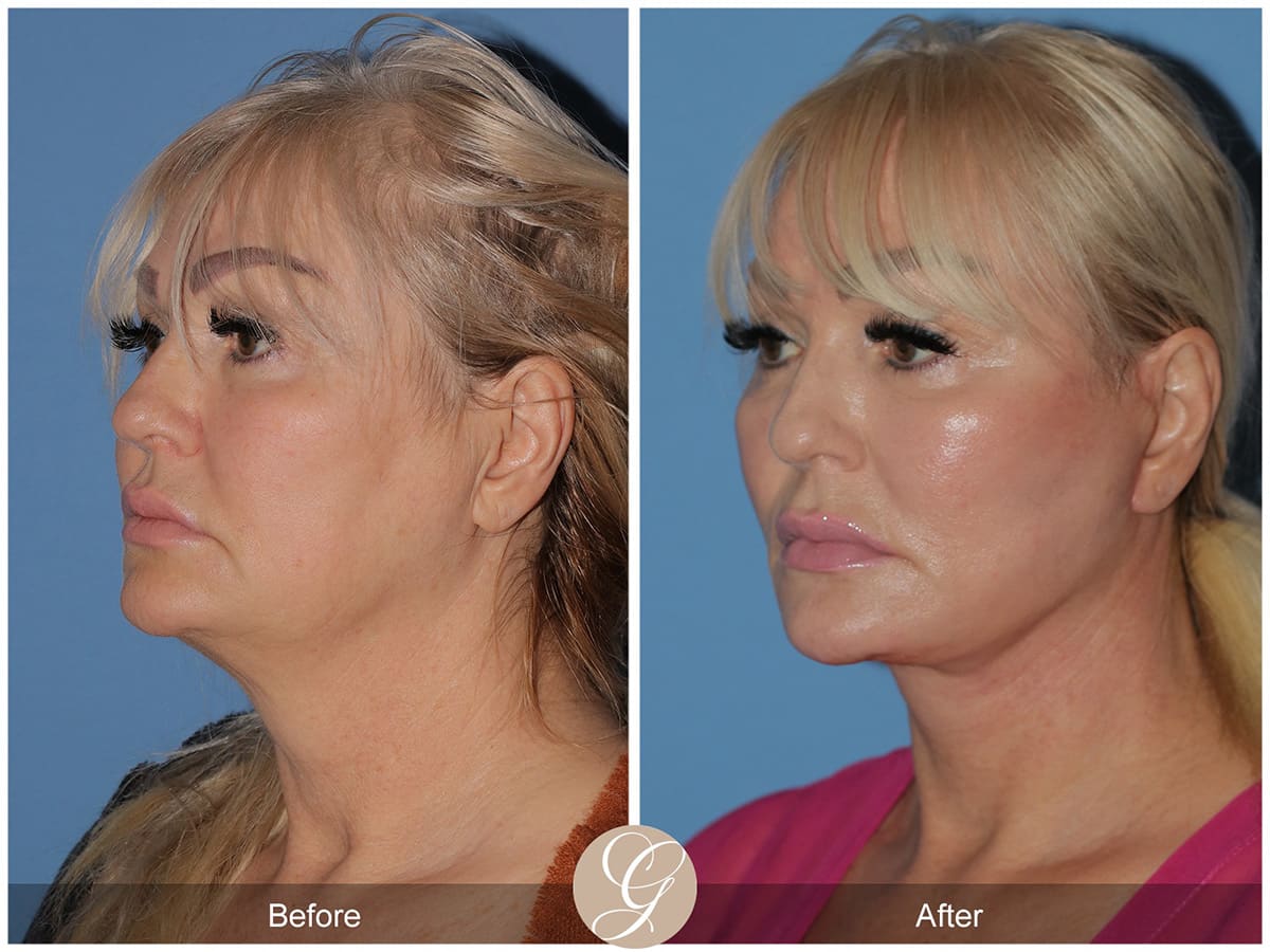 Face Galleries Before & After Image