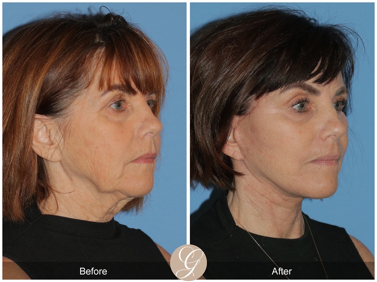 Face Galleries Before & After Image