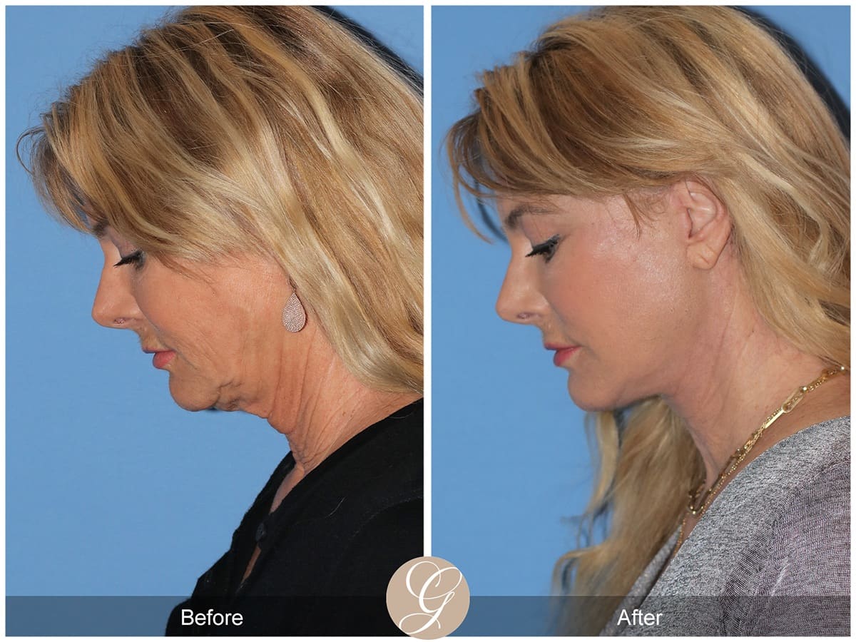 Face Galleries Before & After Image