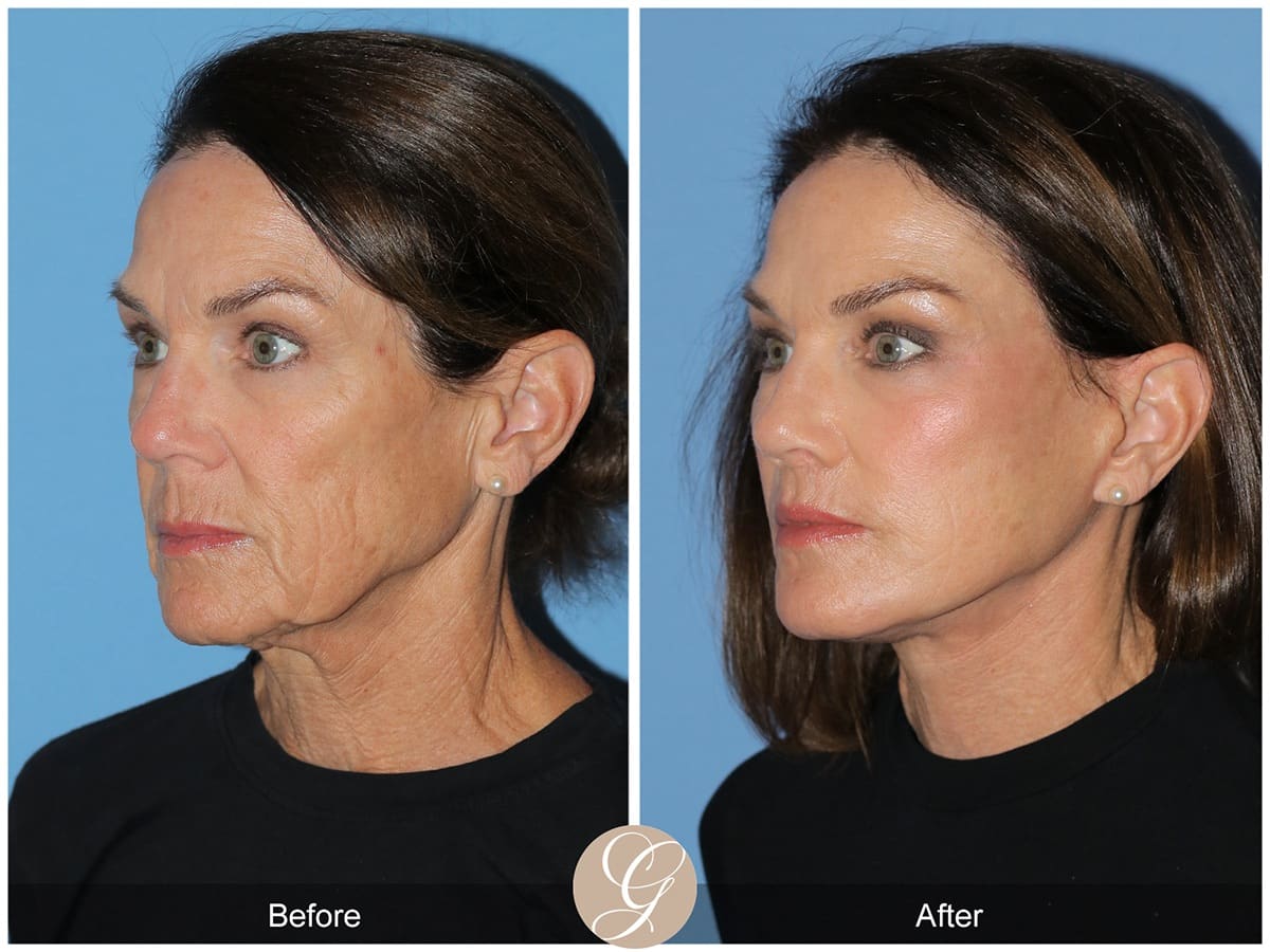 Face Galleries Before & After Image