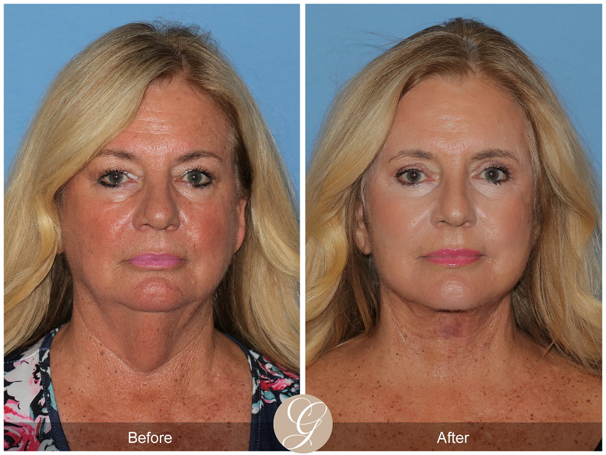 Face Galleries Before & After Image