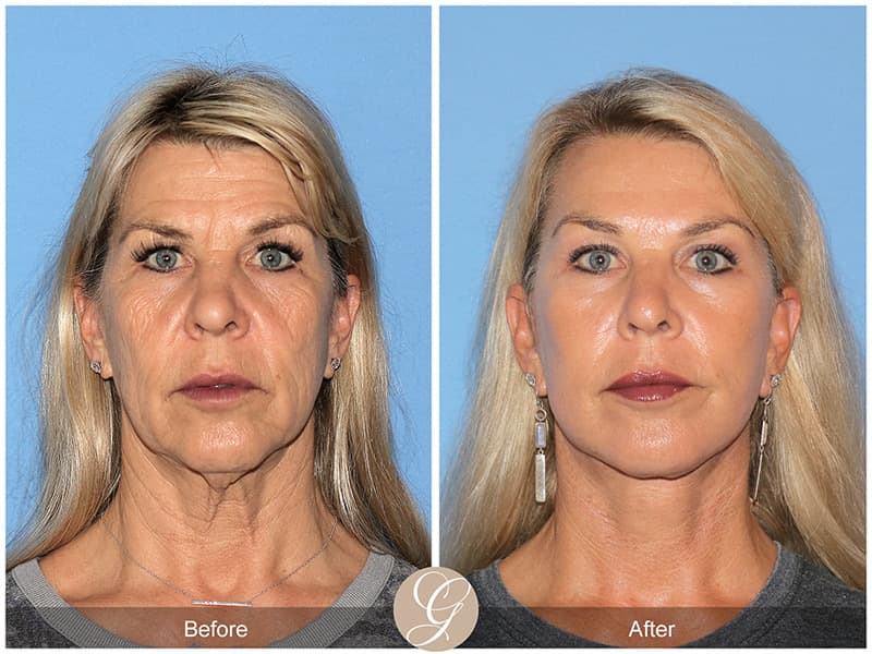 Before After Face Procedures In Newport Beach CA Orange County 