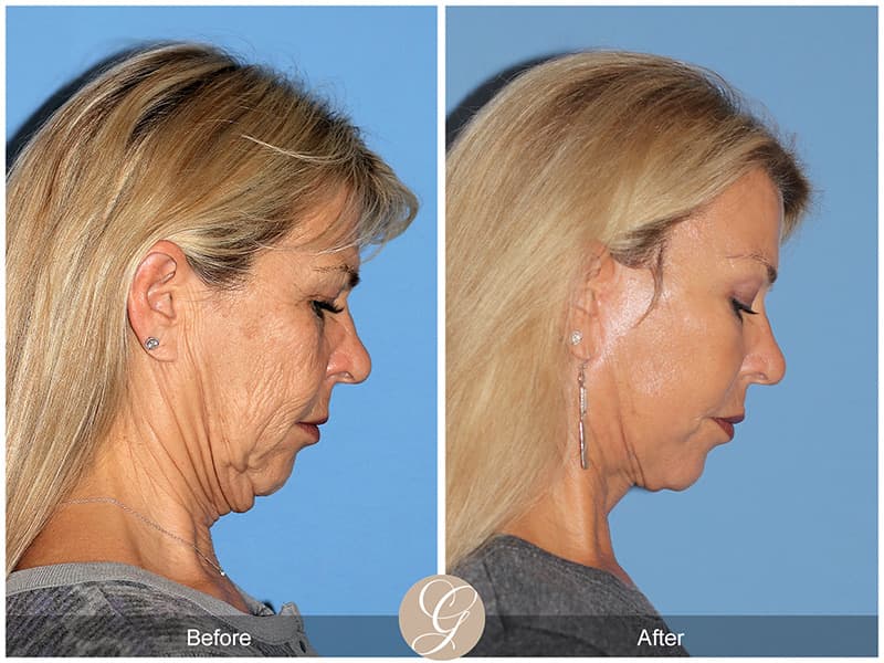 Face Galleries Before & After Image