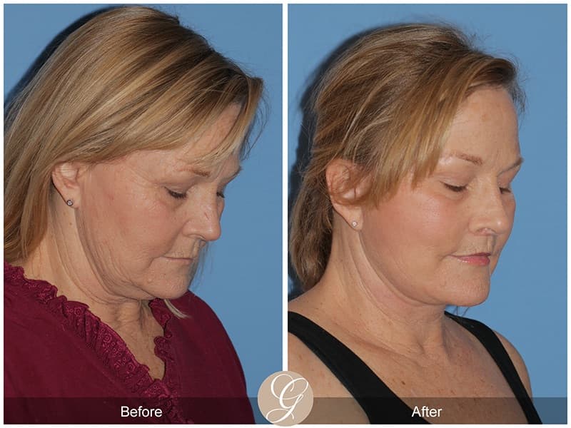 Face Galleries Before & After Image