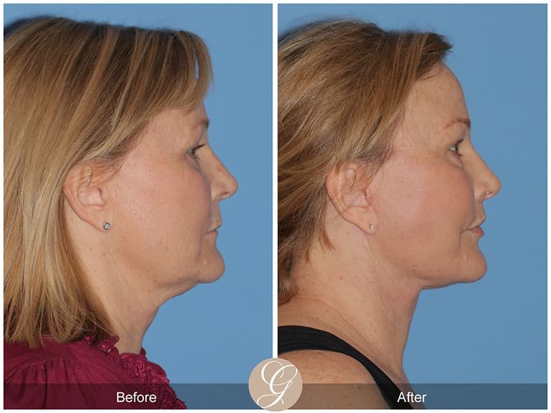 Face Galleries Before & After Image