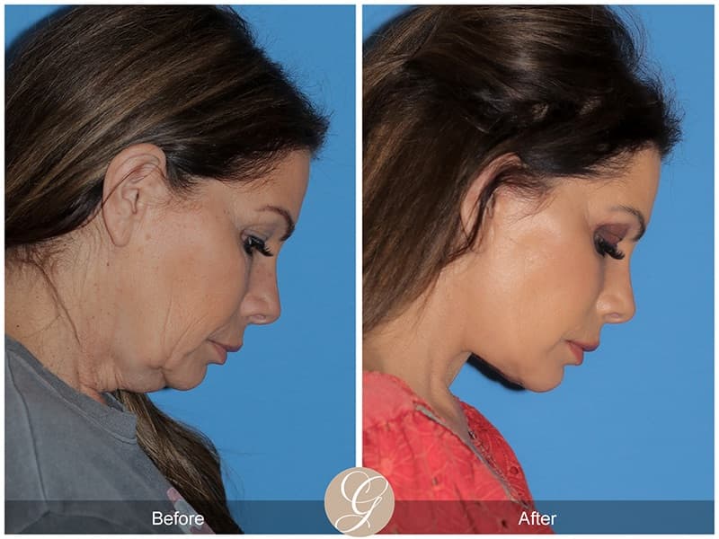 Face Galleries Before & After Image