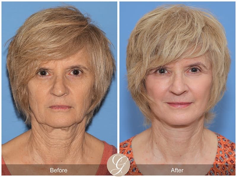 Face Galleries Before & After Image