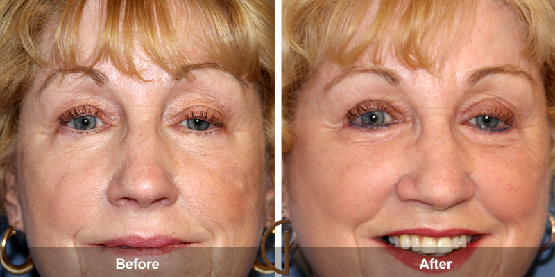 Eyelid Surgery Before & After Image