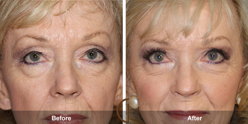 Eyelid Surgery Before & After Image