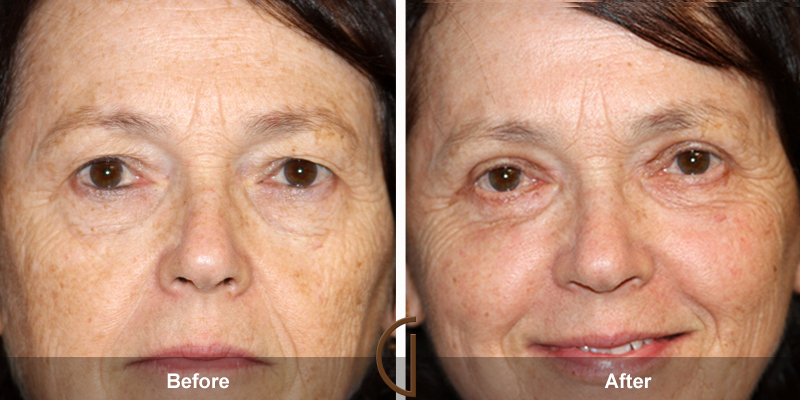 Eyelid Surgery Before & After Image