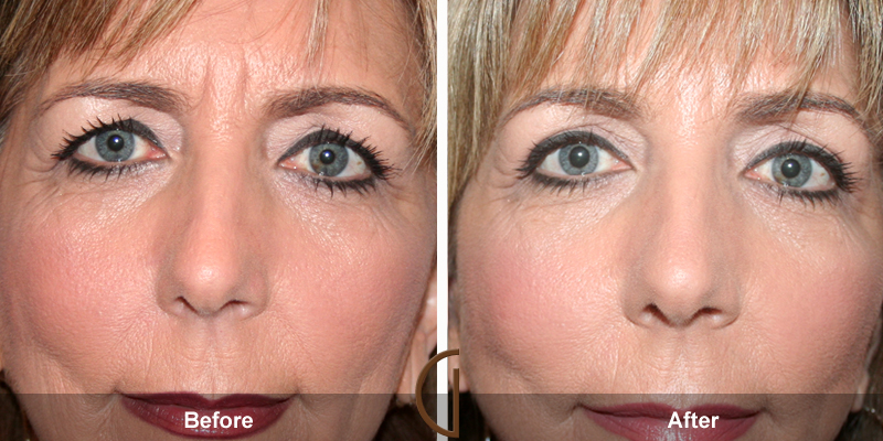 Eyelid Surgery Before & After Image