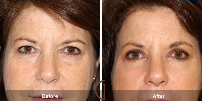 Eyelid Surgery Before & After Image