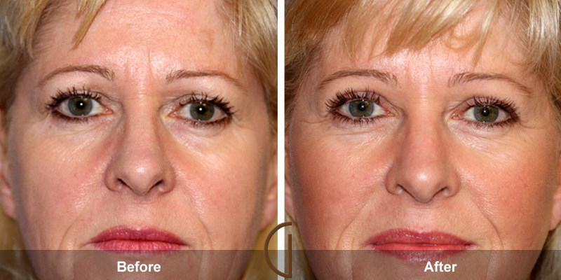 Eyelid Surgery Before & After Image