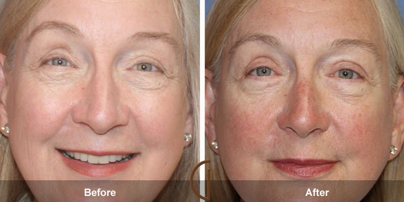 Eyelid Surgery Before & After Image