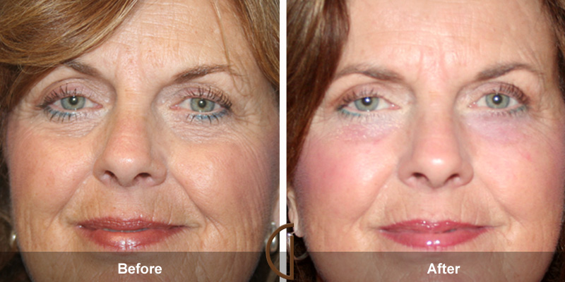 Eyelid Surgery Before & After Image