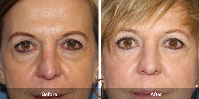 Eyelid Surgery Before & After Image