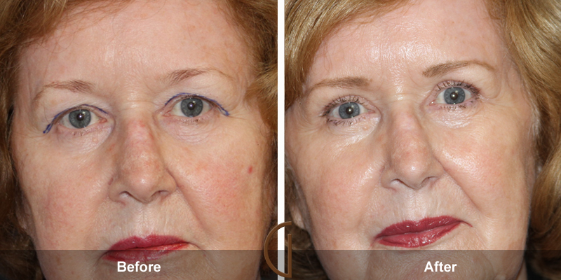 Eyelid Surgery Before & After Image