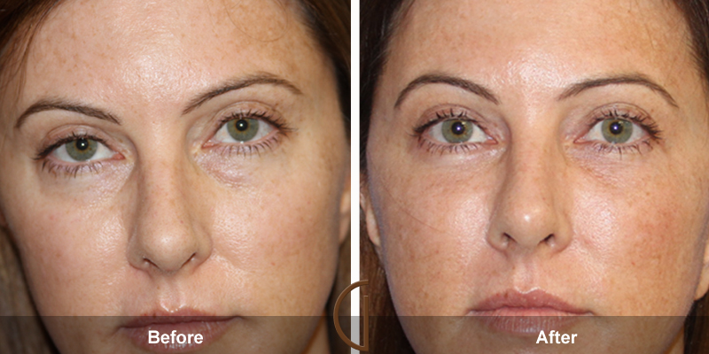 Eyelid Surgery Before & After Image