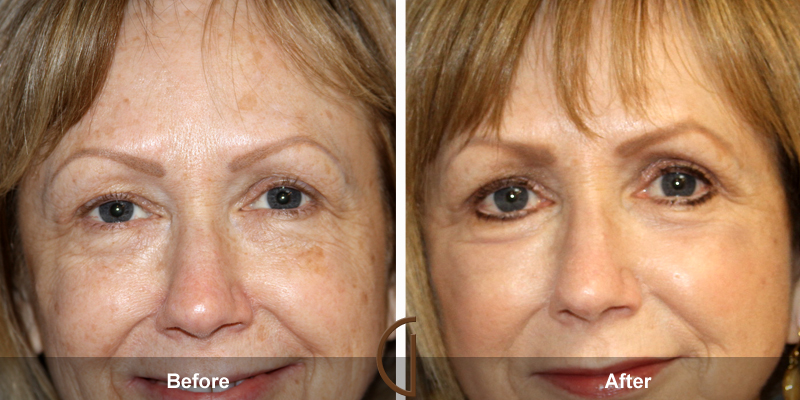 Eyelid Surgery Before & After Image