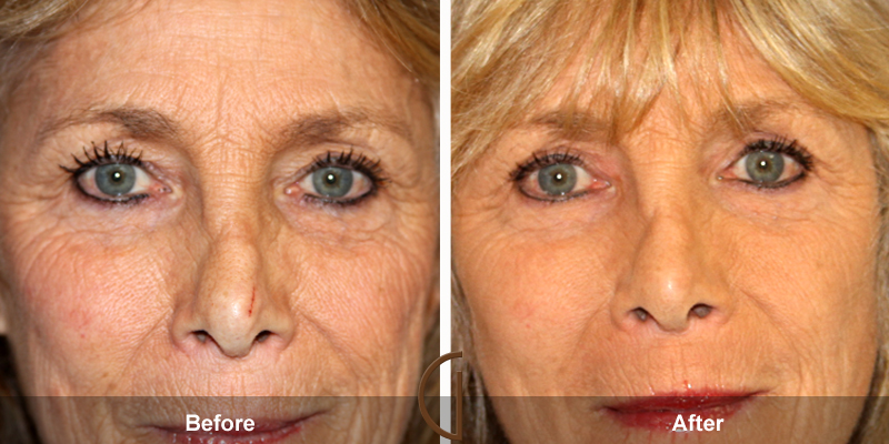 Eyelid Surgery Before & After Image