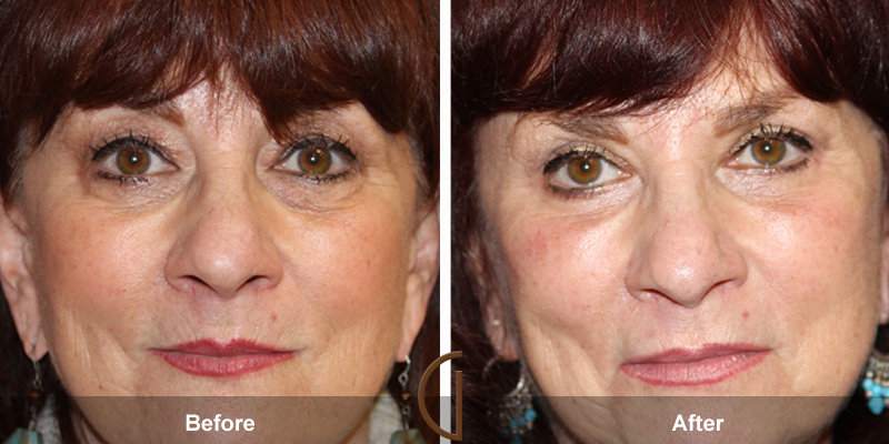 Eyelid Surgery Before & After Image