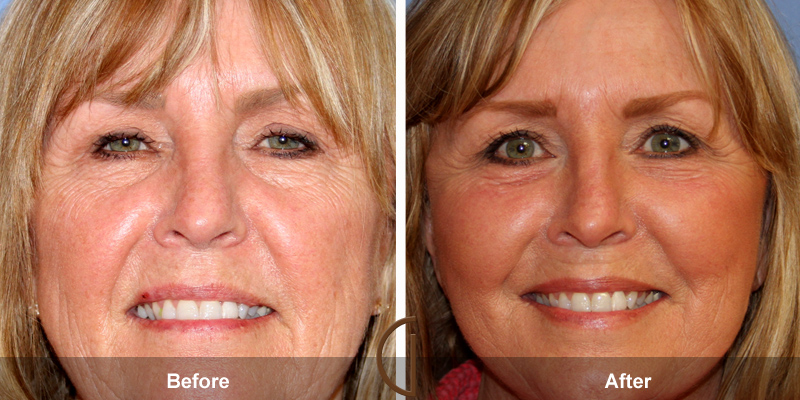 Eyelid Surgery Before & After Image